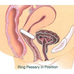  Gyn & Ring - anneau Pessaire - 89 mm T7- Gyneas - 